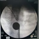 Boğazına Madeni Para Kaçan Çocuğun Boğazındaki Para, Uzman Ekip Tarafından Çıkartıldı