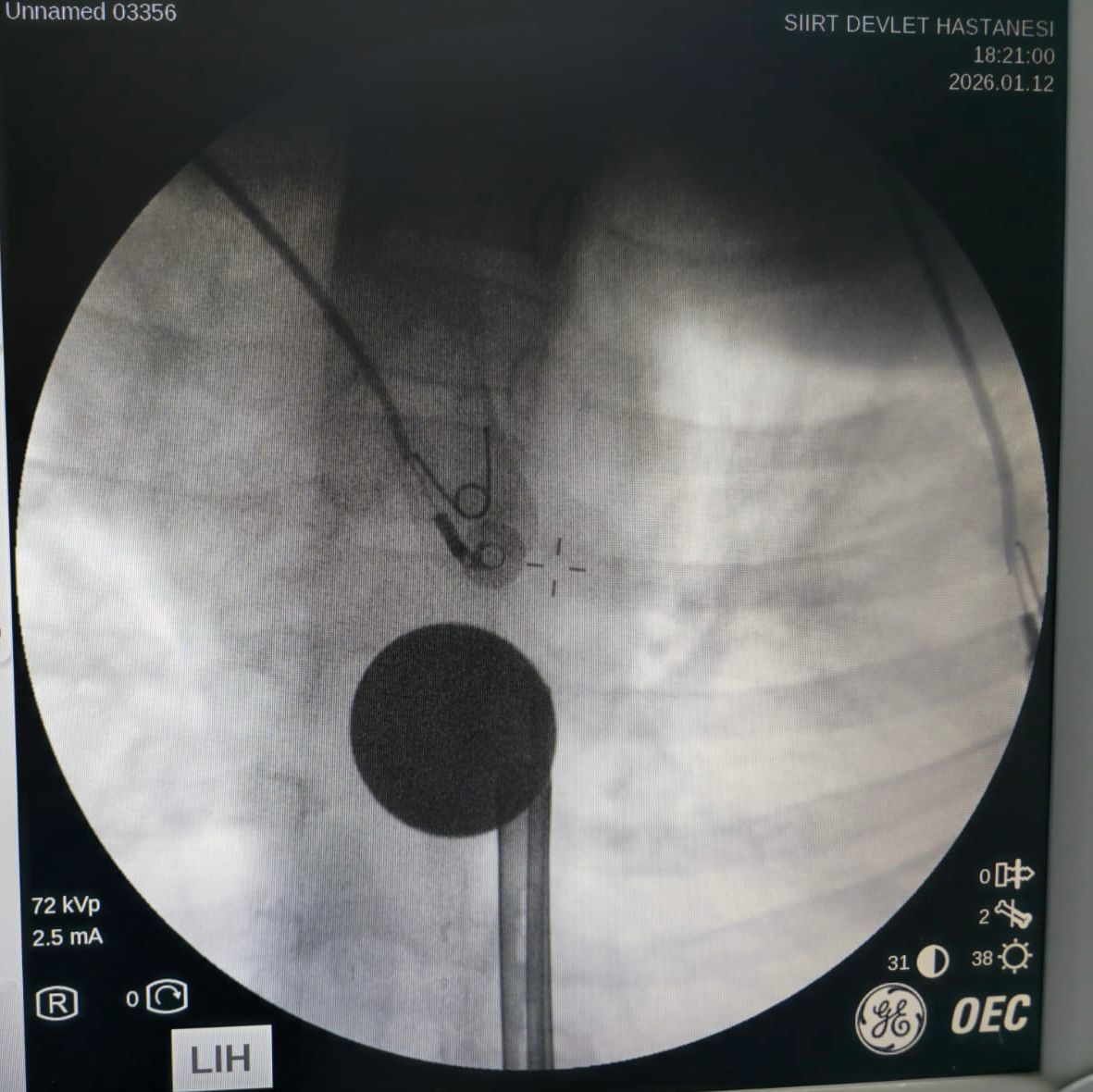 Boğazına Madeni Para Kaçan Çocuğun Boğazındaki Para, Uzman Ekip Tarafından Çıkartıldı